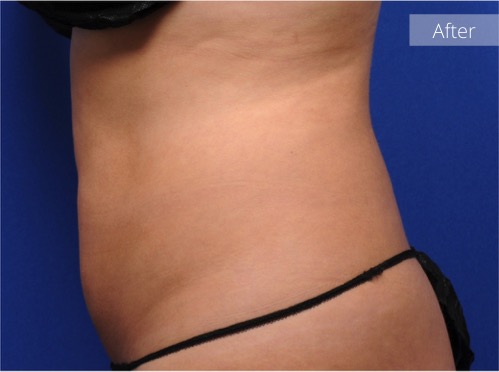 side view of abdomen after CoolSculpting