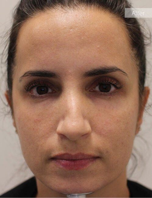 Photo of woman after filler treatment