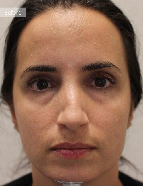 Photo of woman before filler treatment