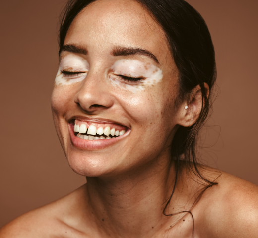 Face of a woman with Vitiligo