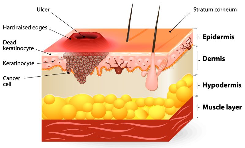 Melanoma Skin Cancer Diagram