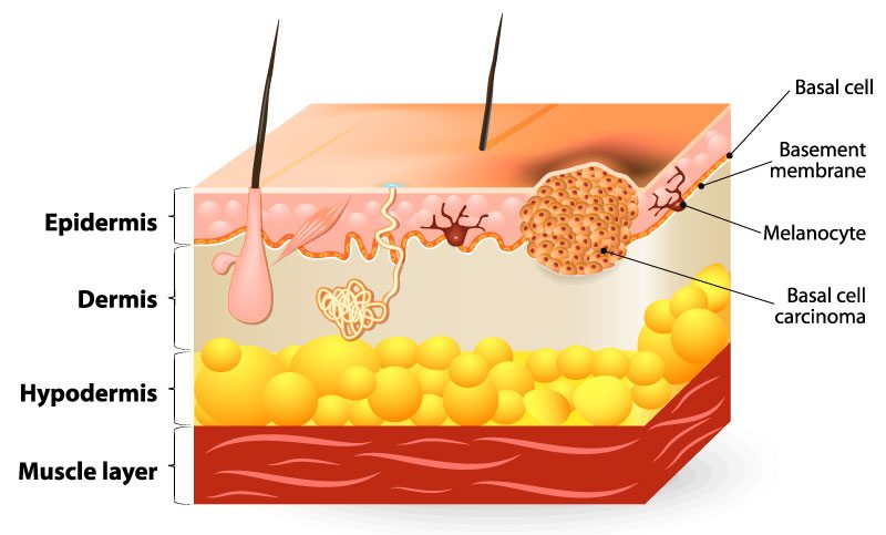 diagram of basal cell carcinoma