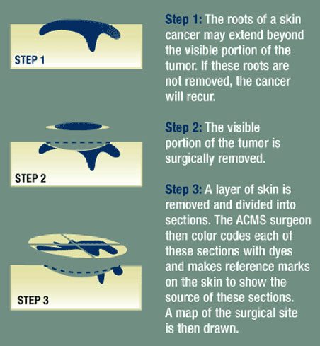 diagram of mohs surgery process