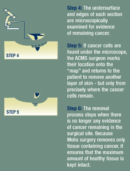 diagram of mohs surgery process