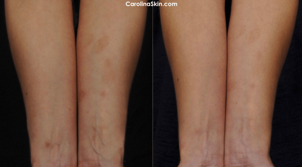 before and after pictures of laser scar treatment