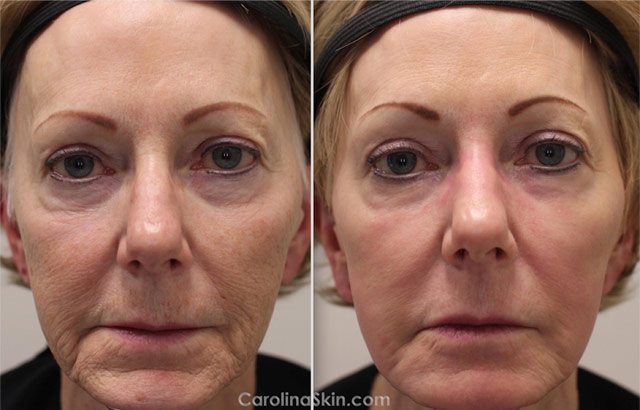 female face laser resurfacing before and after results
