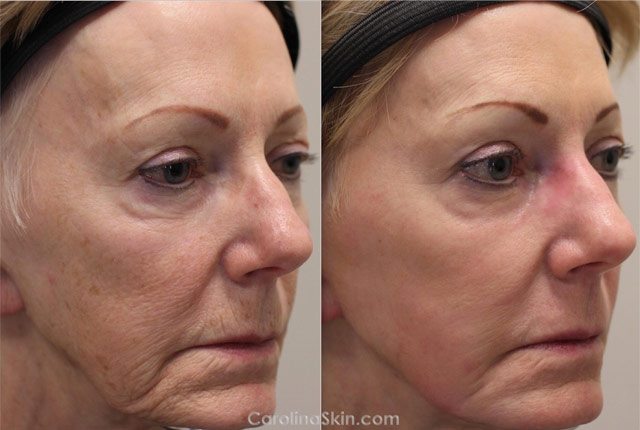 female face laser resurfacing before and after results