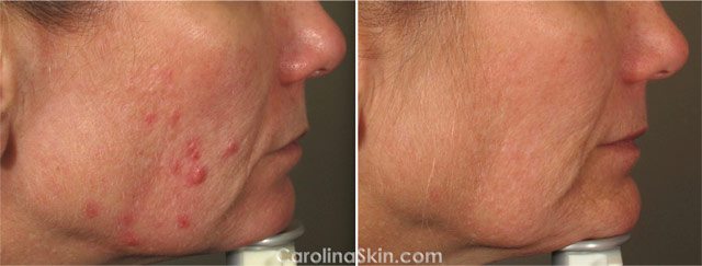 before and after results of laser treatment for adult acne