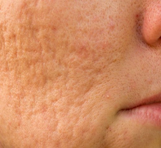 close up of face with acne scars