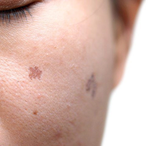 human face with brown spots on the cheek