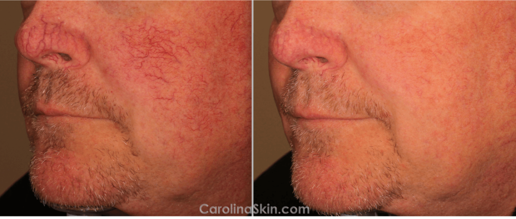 before and after pictures of laser treatment for facial redness