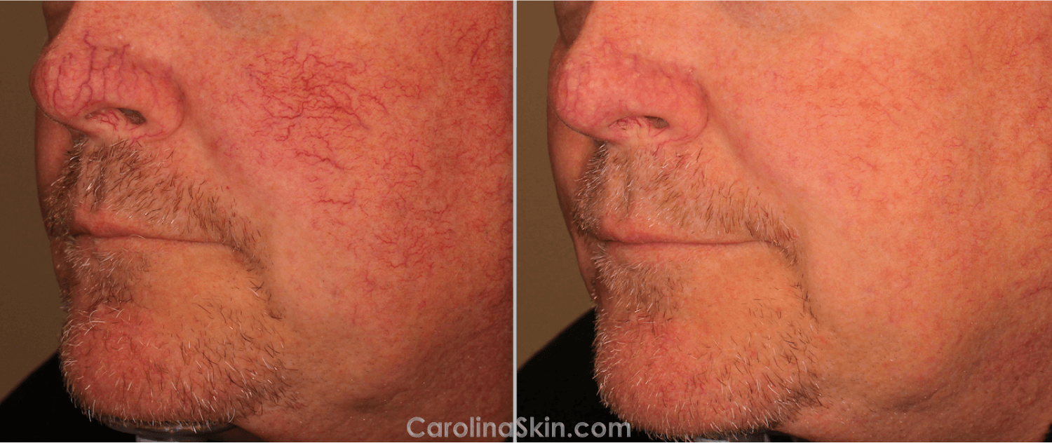 Clarity For Facial Vessels Dermatology Laser And Vein Specialists Of