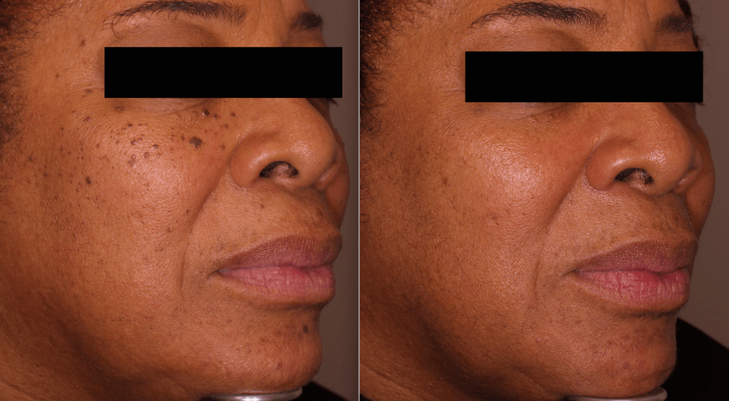 Gemini laser before and after pictures of DPN treatment