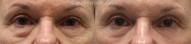 Blepharoplasty eyelid surgery before and after results