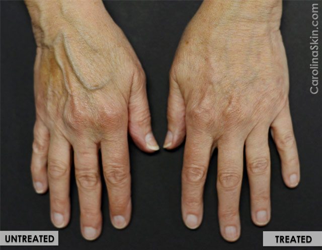 Radiesse hand filler treatment results