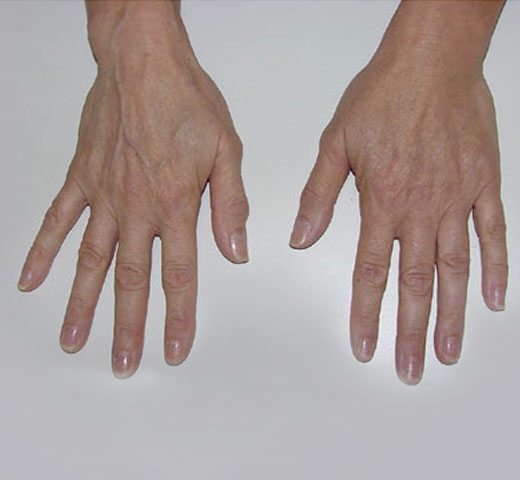 Hand Vein Treatments | Dermatology, Laser & Vein Specialists of the ...