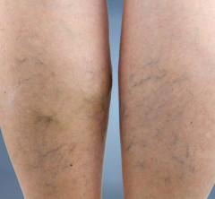 example of lower leg reticular veins