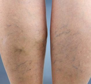 example of lower leg reticular veins