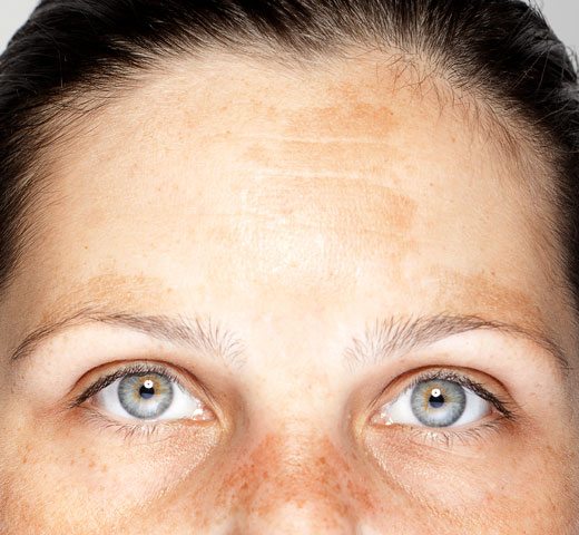 example of melasma