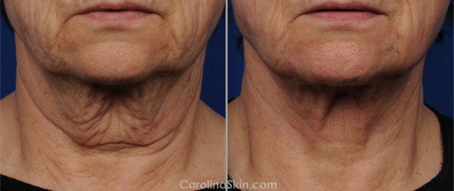 female neck laser liposuction before and after results