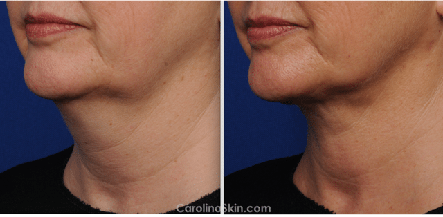 female neck laser liposuction before and after pictures