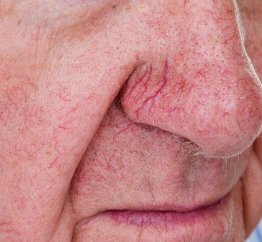 Example of facial redness and veins