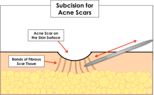 diagram showing how subcision for acne scars works