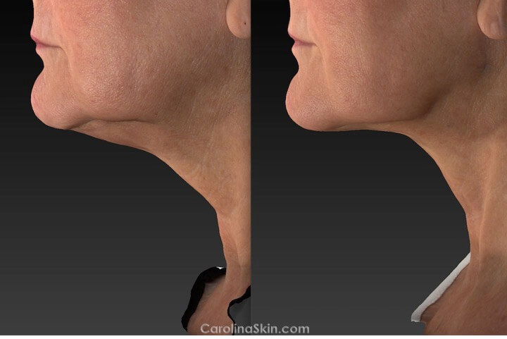 Double Chin Neck Fat And Skin Tightening Treatments Charlotte Dlvsc