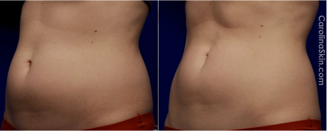 UltraShape before and after results for abdomen of female