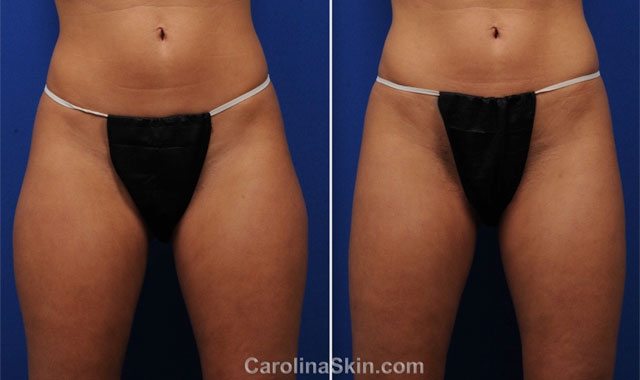 Tumescent Liposuction before and after results for inner and outer thighs