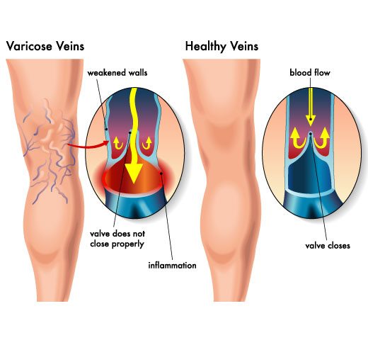 Diagram of varicose veins