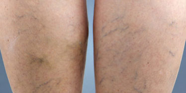 example of reticular leg veins