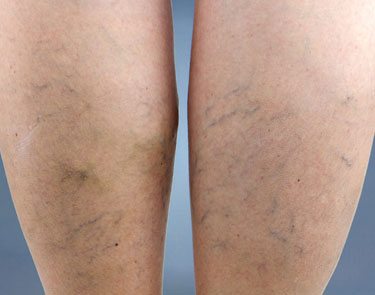 example of reticular leg veins