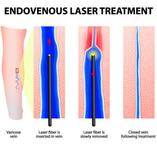 diagram of endovenous laser treatment