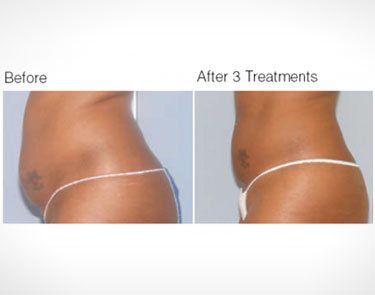 news_ultrashapeT news_ultrashapeT