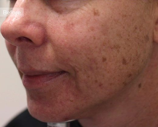 female face before IPL for brown spots