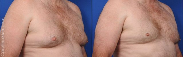 Coolsculpting® results for pseudogynecomastia or enlarged male breasts