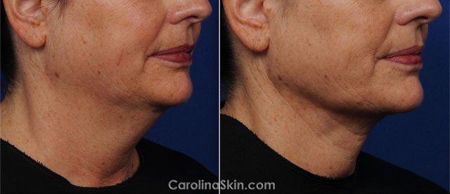 laser liposuction before and after pictures for neck