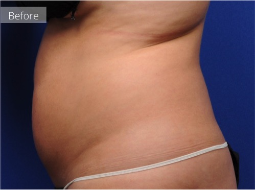 side view of abdomen before CoolSculpting