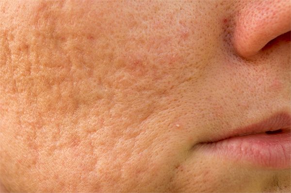 microneedling_acnescars