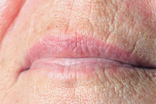 microneedling_lipwrinkles