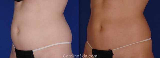 CoolSculpting before and after results for abdominal fat
