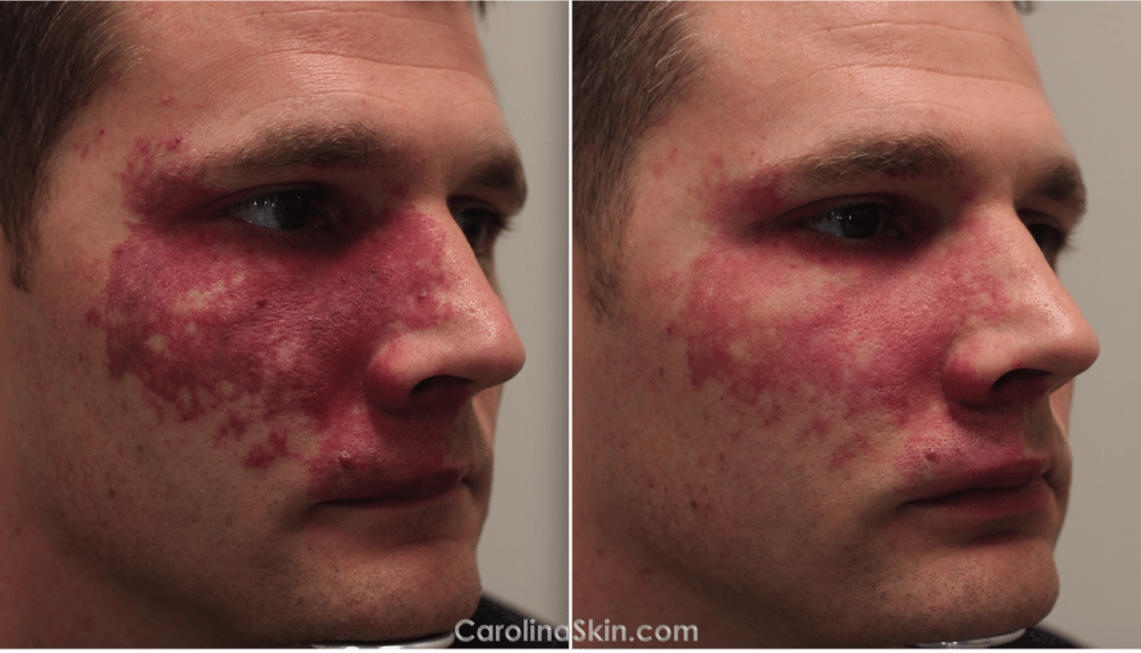 port-wine stain birthmark laser treatment results