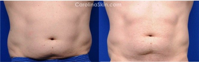 CoolSculpting before and after pictures for male abdomen