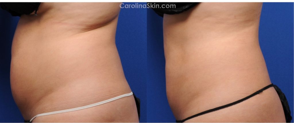 Side View of CoolSculpting Before & After Results