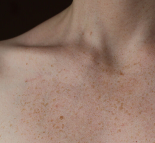 example of brown spots on female chest