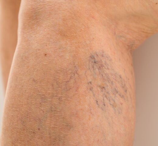 example of spider veins on a leg