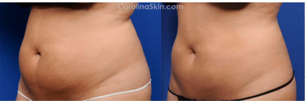 CoolSculpting for abdomen and love handles before and after results