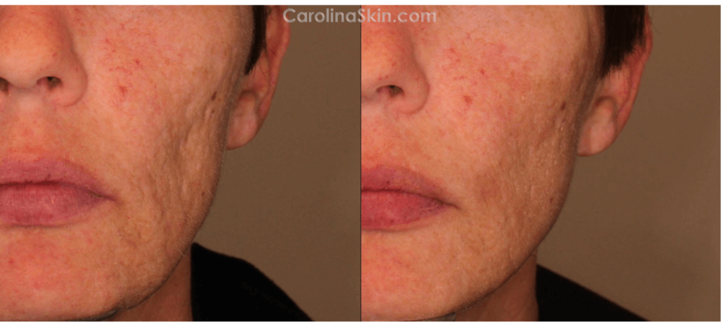 close up view of acne scar treatment before and after results