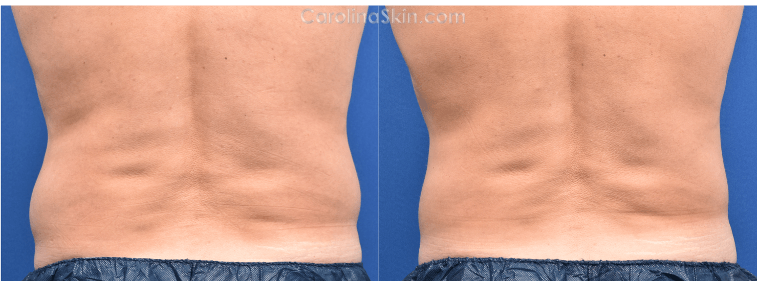 before and after results from CoolSculpting for love handles